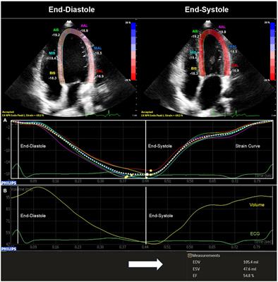 Left ventricular systolic function in subjects conceived through assisted reproductive technologies